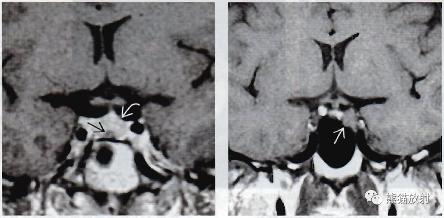 ​垂体微腺瘤、垂体大腺瘤影像诊断要点-2