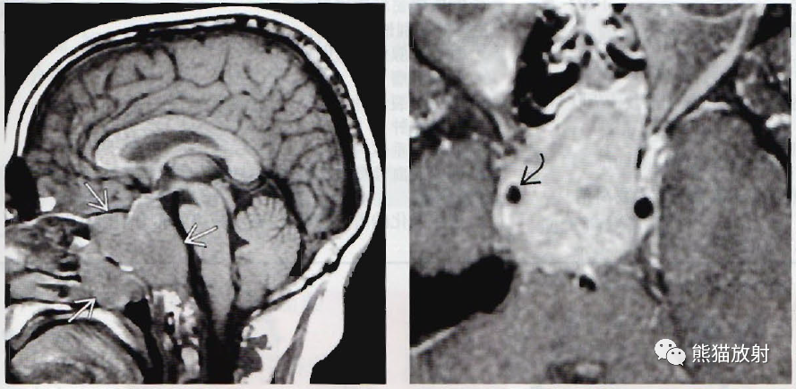 ​垂体微腺瘤、垂体大腺瘤影像诊断要点-7