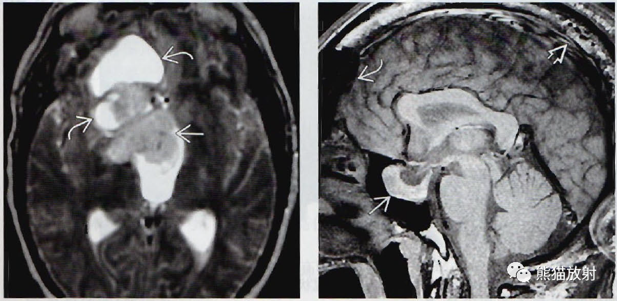 ​垂体微腺瘤、垂体大腺瘤影像诊断要点-9