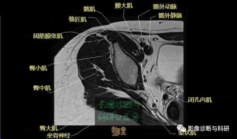 髋关节MR轴位详细标注-5