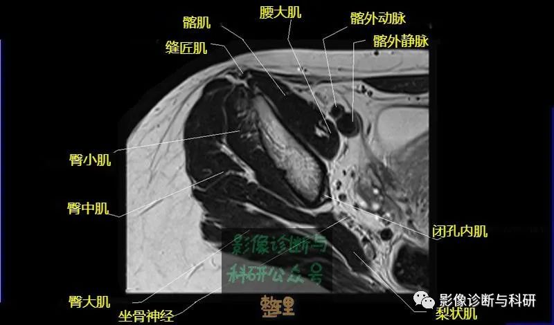髋关节MR轴位详细标注-3