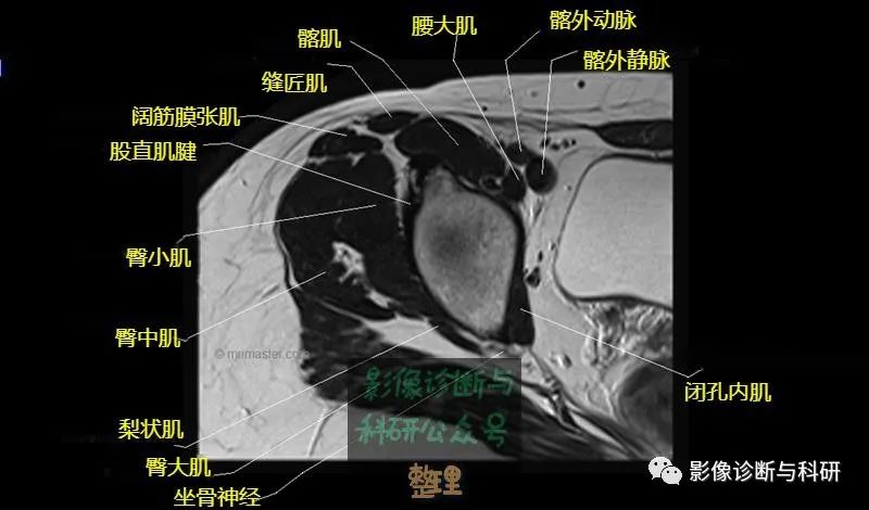 髋关节MR轴位详细标注-7