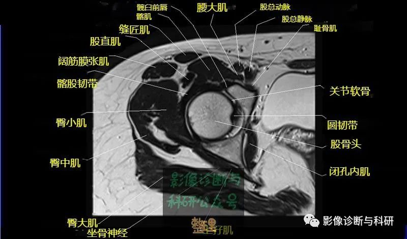 髋关节MR轴位详细标注-10