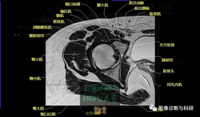 髋关节MR轴位详细标注-11