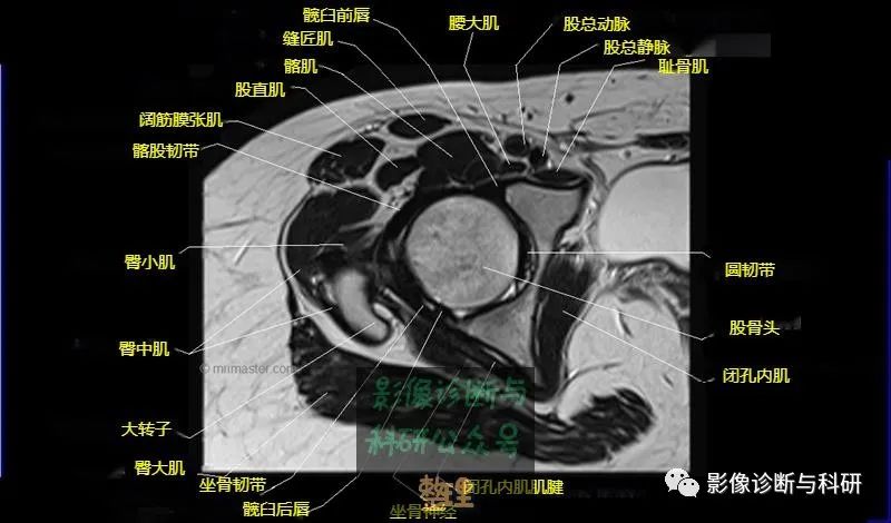 髋关节MR轴位详细标注-12