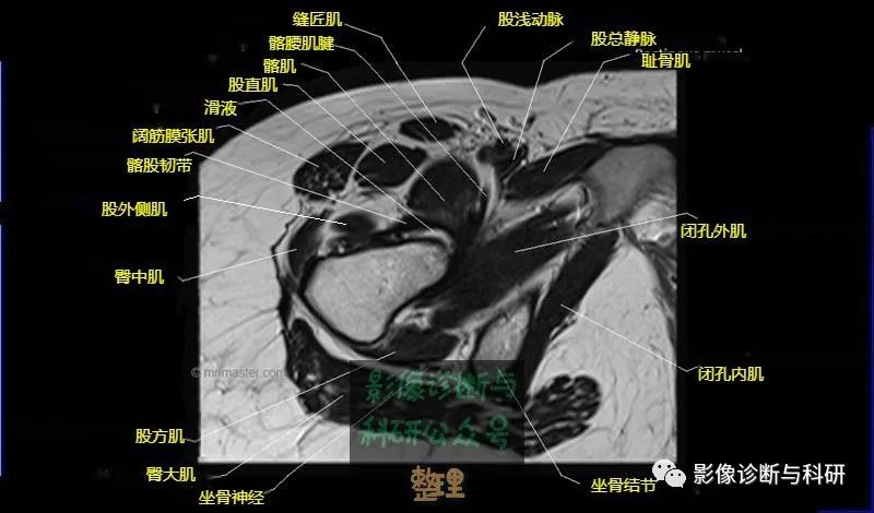 髋关节MR轴位详细标注-16