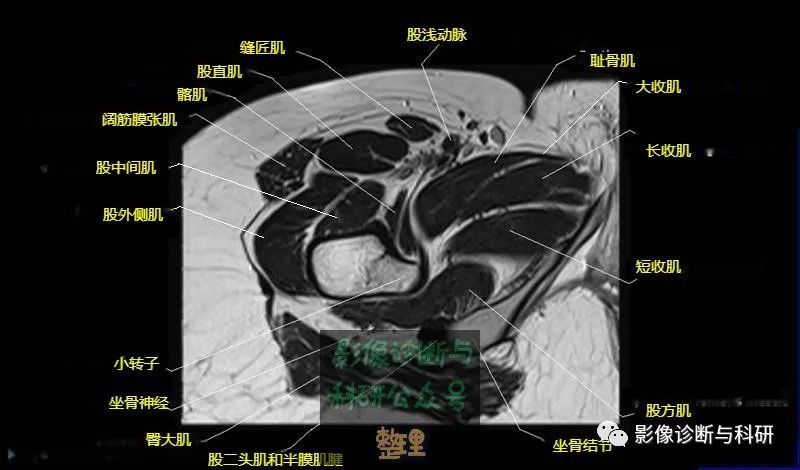 髋关节MR轴位详细标注-21