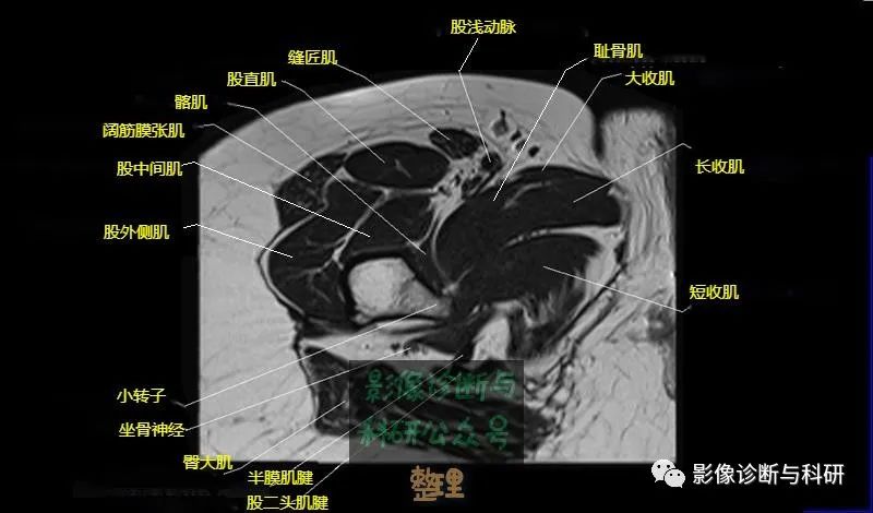 髋关节MR轴位详细标注-23