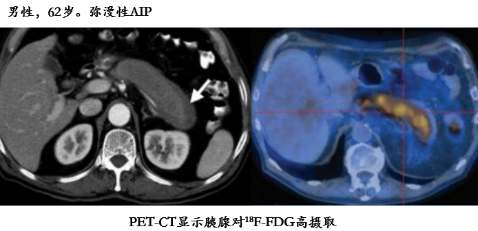 自身免疫性胰腺炎的影像学表现-13