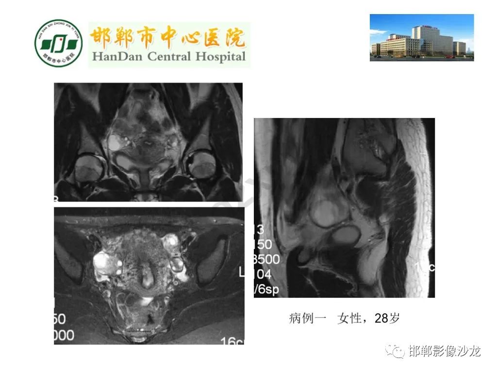 【PPT】卵巢非肿瘤性病变的影像诊断-2