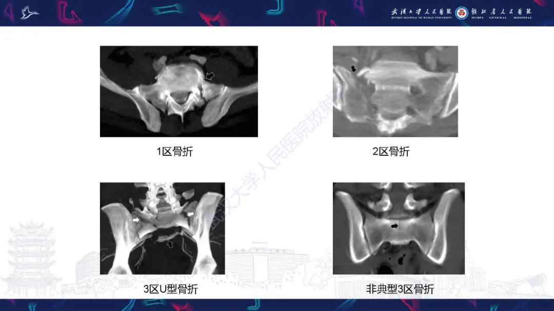 【PPT】骶骨骨折CT评估-11
