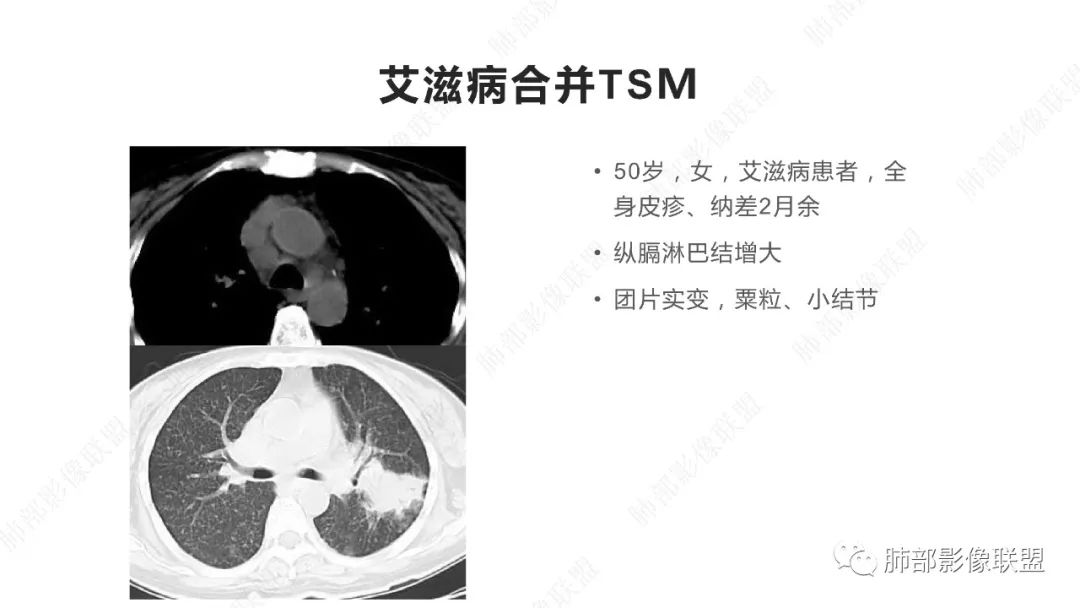 【PPT】马尔尼菲篮状菌的CT表现-9