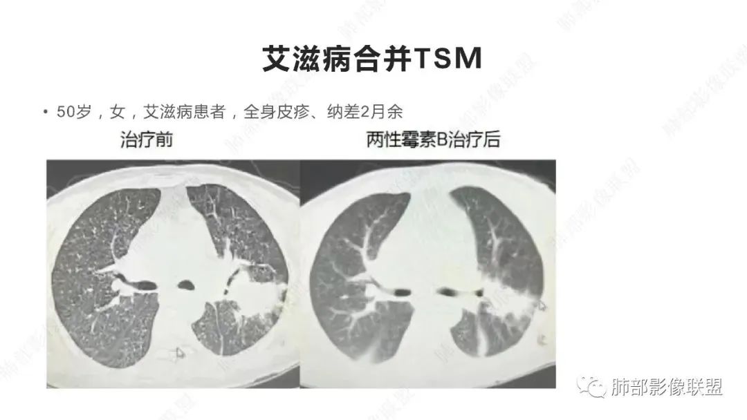 【PPT】马尔尼菲篮状菌的CT表现-10