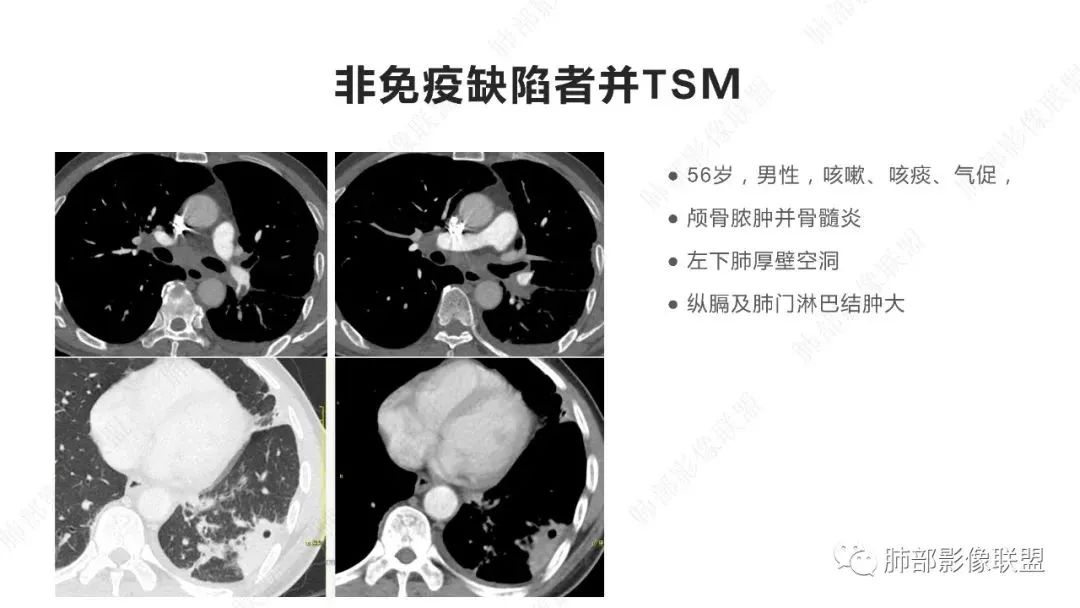 【PPT】马尔尼菲篮状菌的CT表现-14