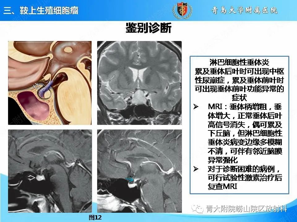 【PPT】颅内生殖细胞瘤的影像学诊断-22