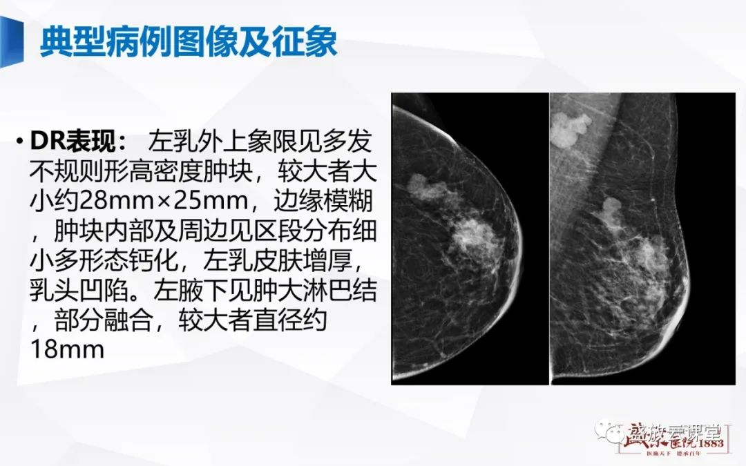 【PPT】乳腺疾病病例读片-4