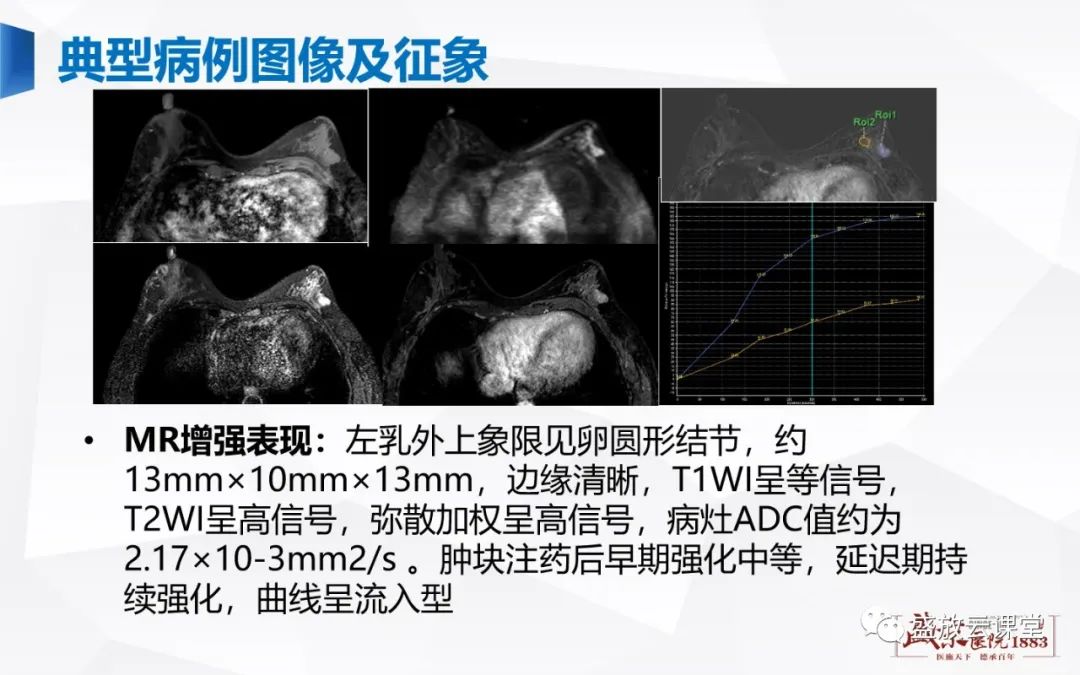 【PPT】乳腺疾病病例读片-18