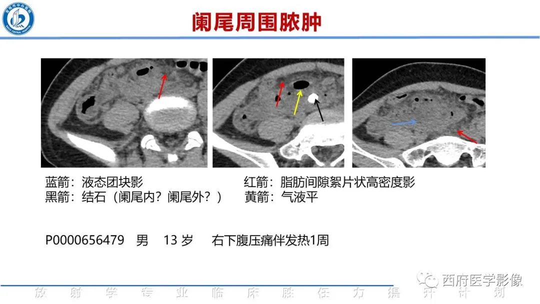 【PPT】阑尾解剖及阑尾炎影像诊断-20