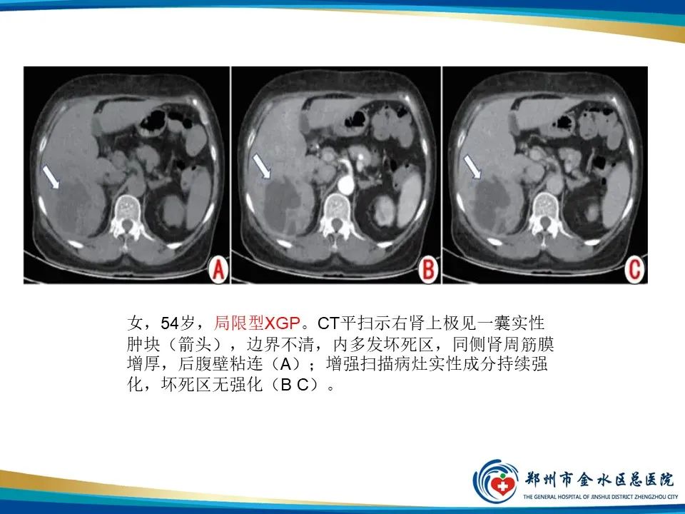 【PPT】黄色肉芽肿性肾盂肾炎影像表现-24