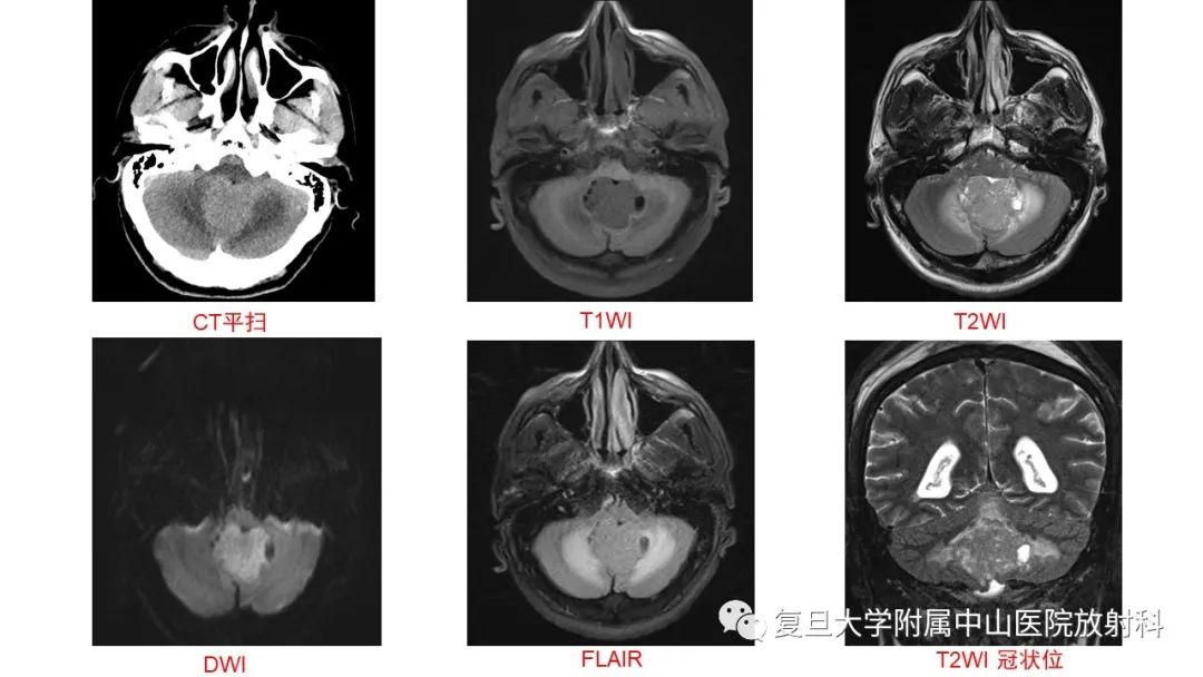 【病例】成人四脑室髓母细胞瘤2例CT及MR-3