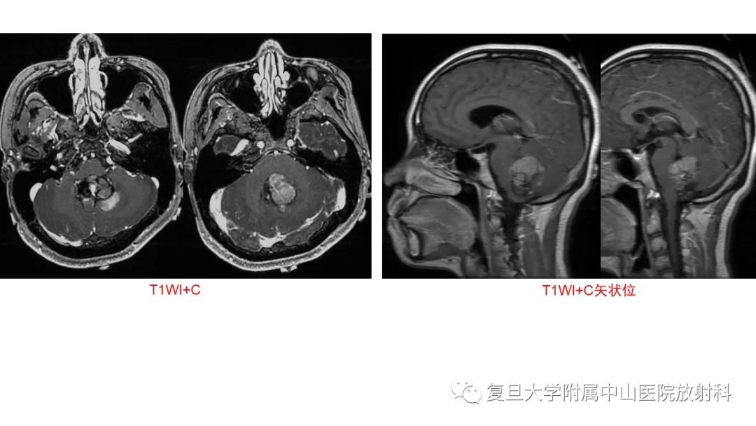 【病例】成人四脑室髓母细胞瘤2例CT及MR-7