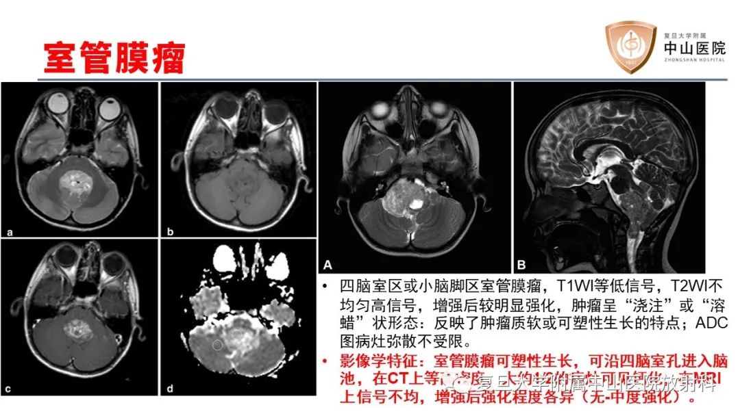 【病例】成人四脑室髓母细胞瘤2例CT及MR-21