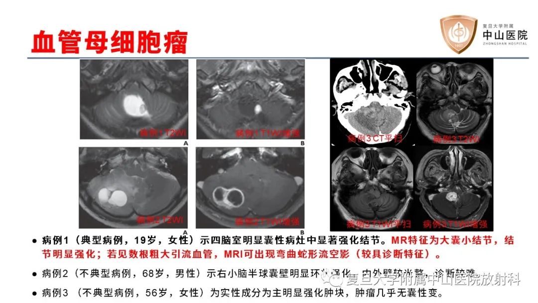 【病例】成人四脑室髓母细胞瘤2例CT及MR-22