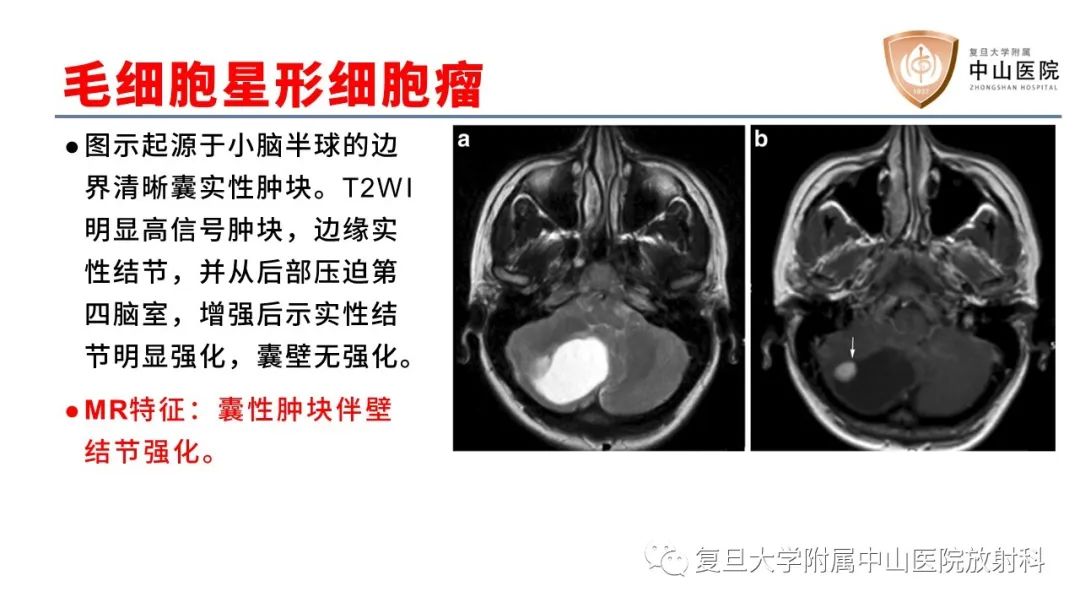 【病例】成人四脑室髓母细胞瘤2例CT及MR-23