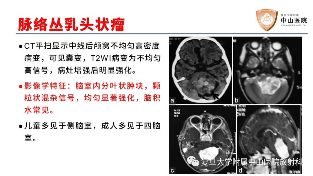 【病例】成人四脑室髓母细胞瘤2例CT及MR-24