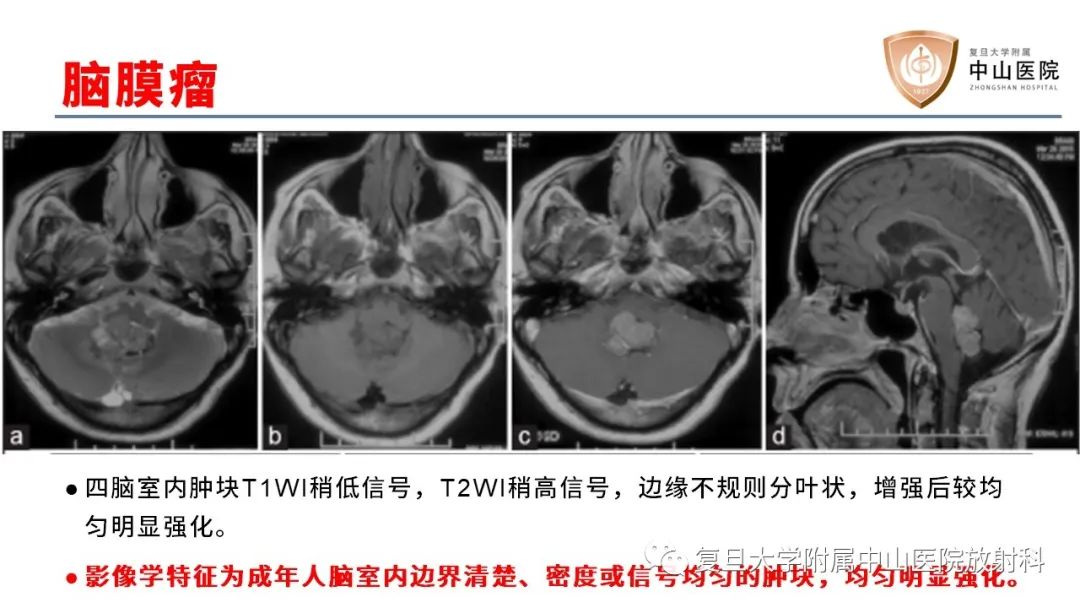 【病例】成人四脑室髓母细胞瘤2例CT及MR-25