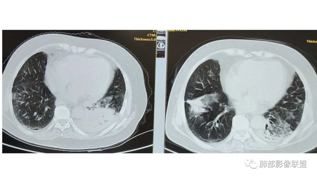 【PPT】肺粘液腺癌—一种疾病，两种表现-47