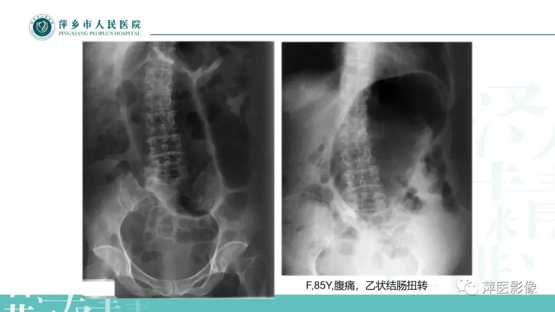 【PPT】腹部X线基础影像-20