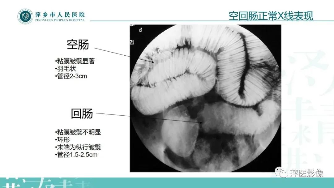 【PPT】腹部X线基础影像-34