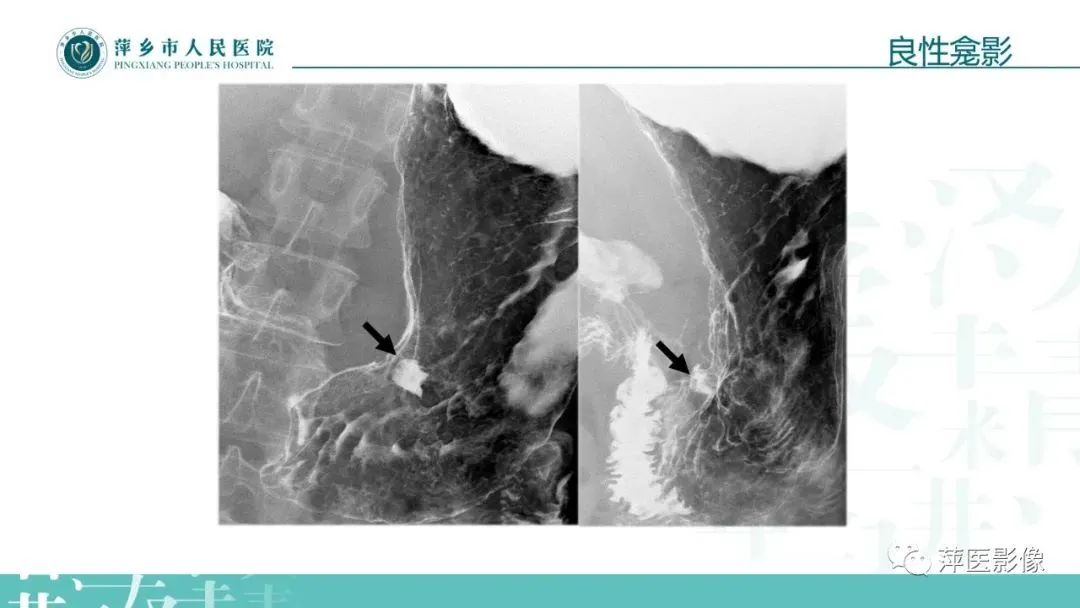 【PPT】腹部X线基础影像-43