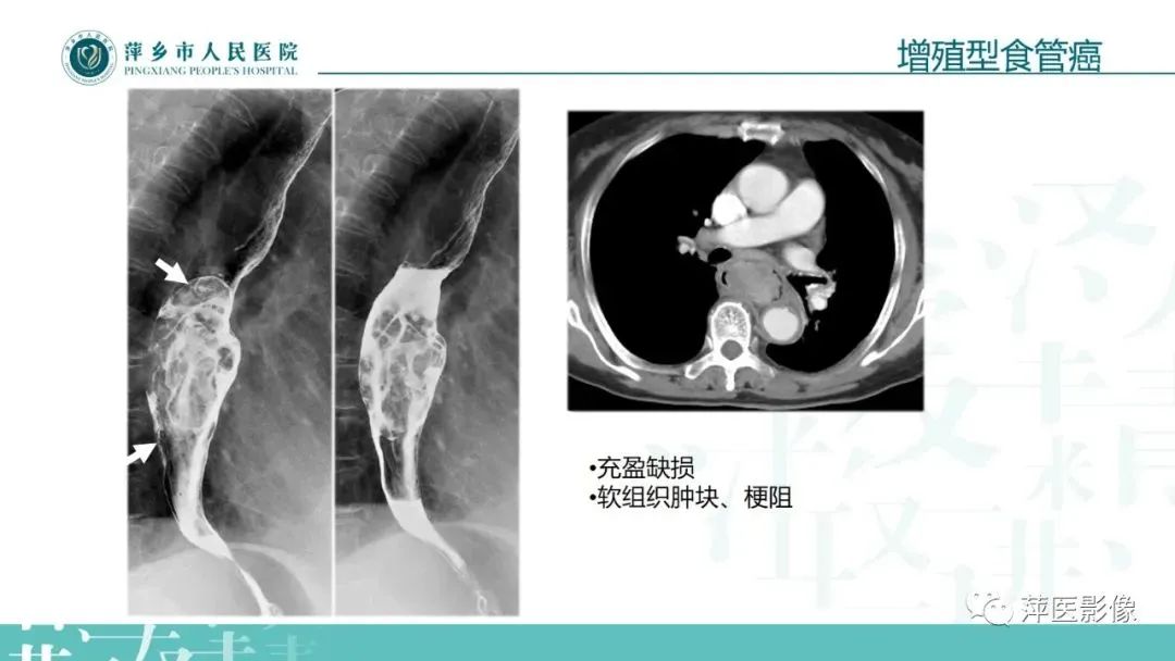 【PPT】腹部X线基础影像-52