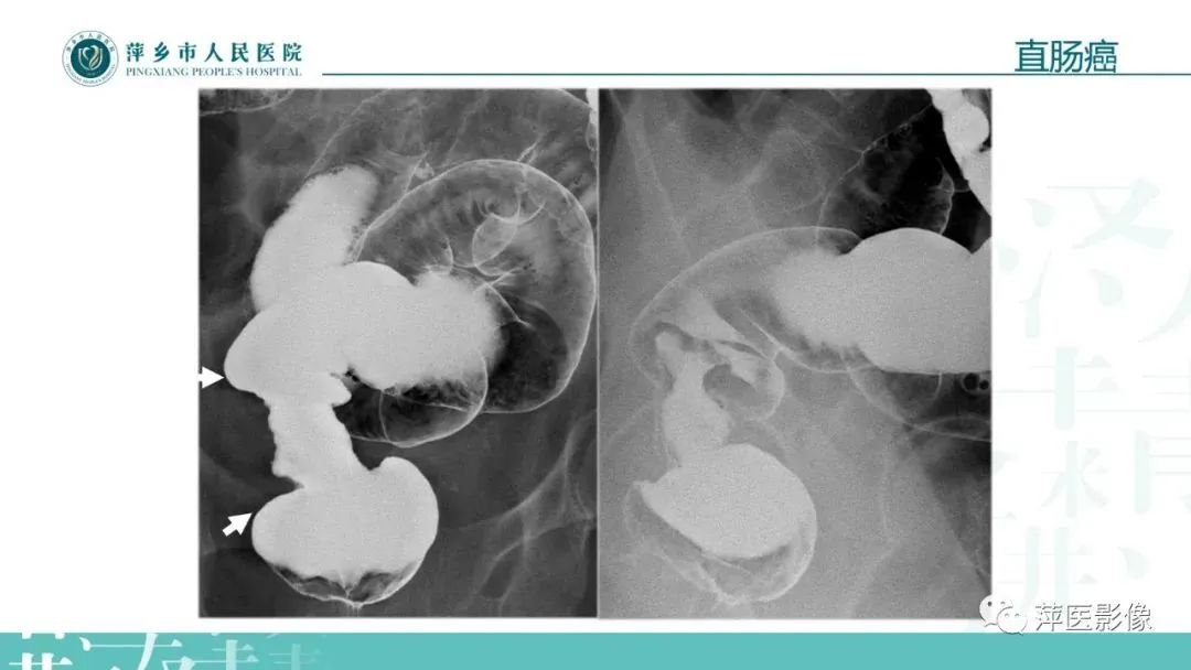【PPT】腹部X线基础影像-62