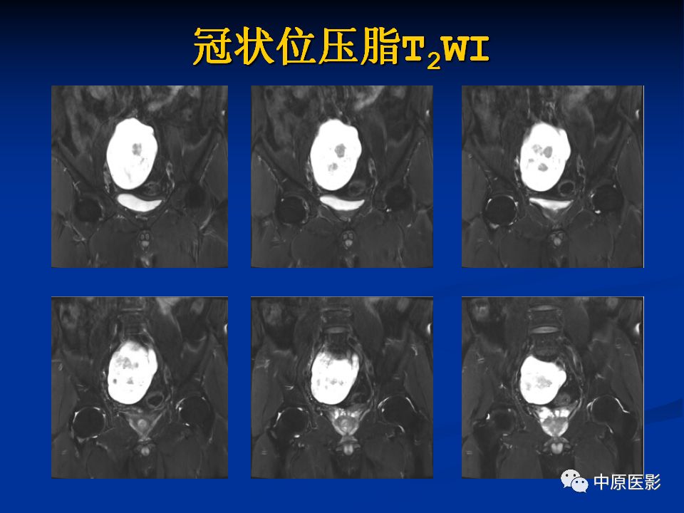 【病例】腹膜后盆腔神经鞘瘤1例MR影像-6