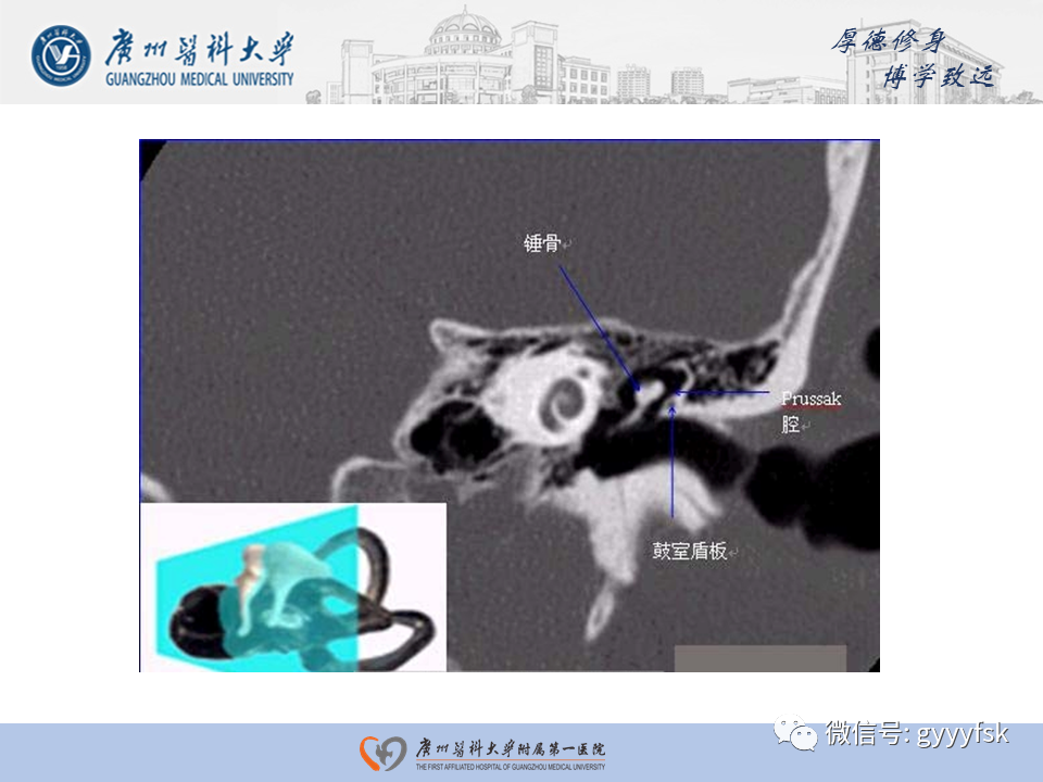 【PPT】中耳胆脂瘤影像阅片-10