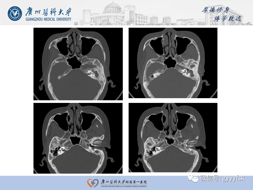 【PPT】中耳胆脂瘤影像阅片-18