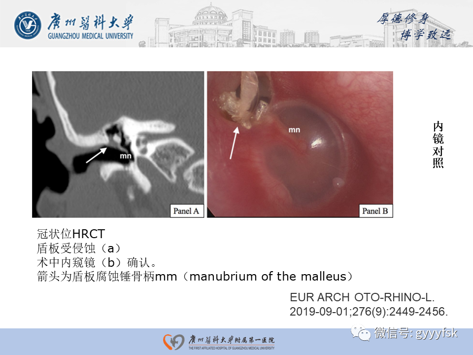 【PPT】中耳胆脂瘤影像阅片-28