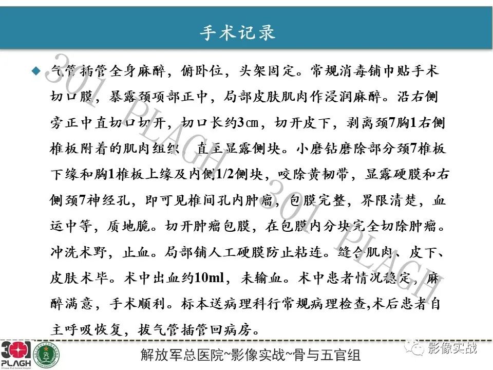 【病例】颈椎脊索瘤1例MR影像-11