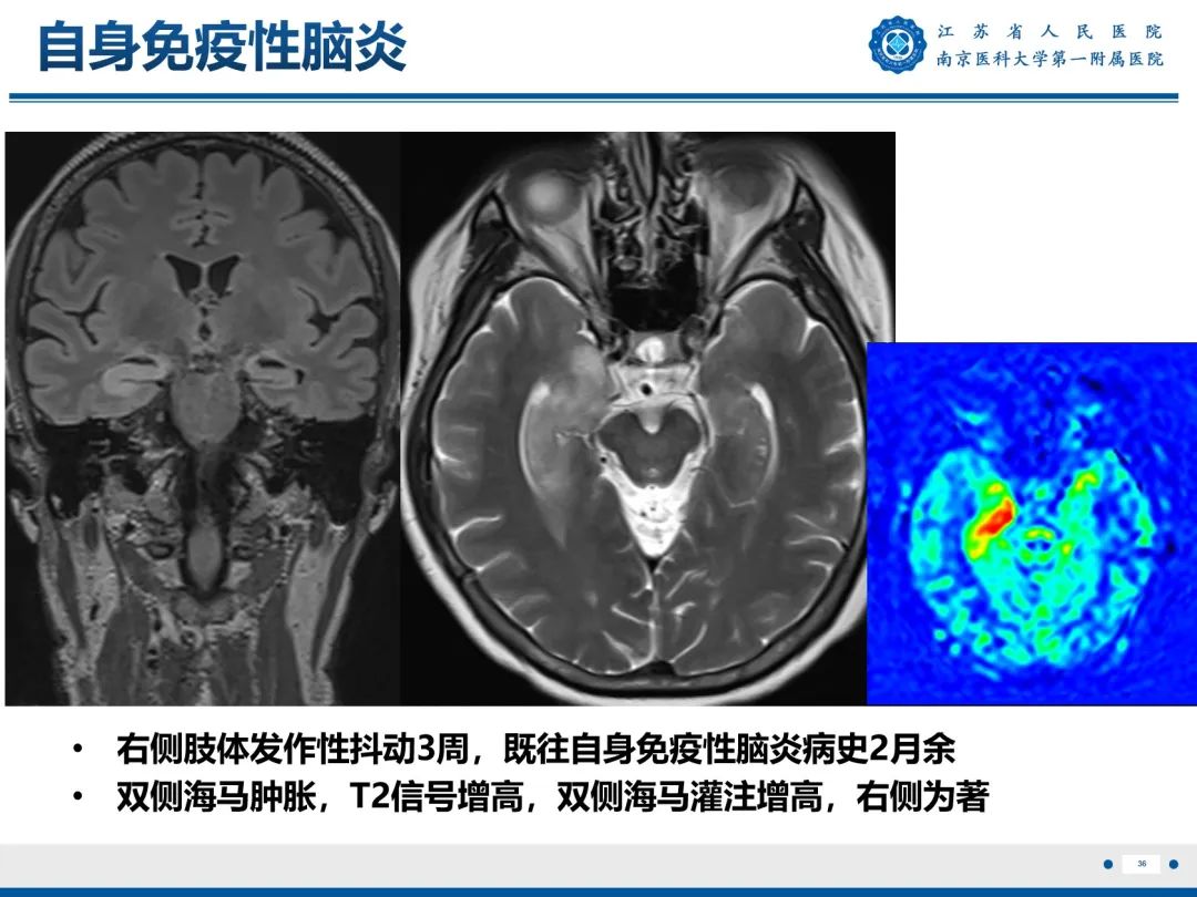 【PPT】​海马硬化-37
