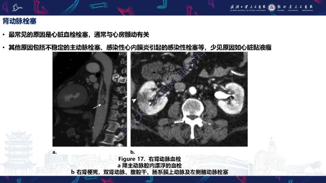 【PPT】肾动脉：解剖、病理及血管内治疗-20