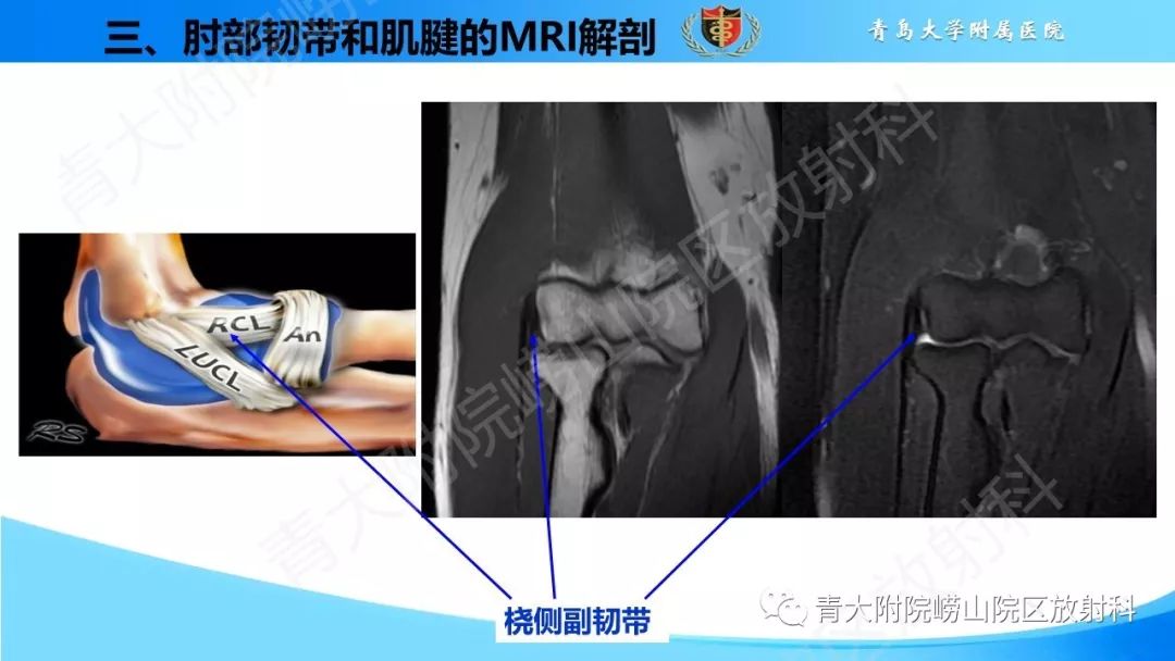 【PPT】肘部韧带和肌腱损伤的MRI诊断-17