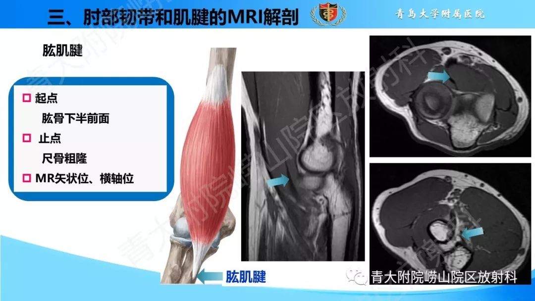 【PPT】肘部韧带和肌腱损伤的MRI诊断-23