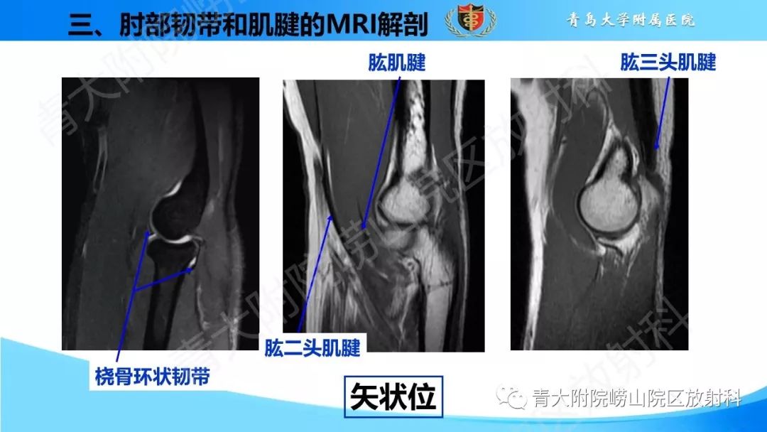 【PPT】肘部韧带和肌腱损伤的MRI诊断-29