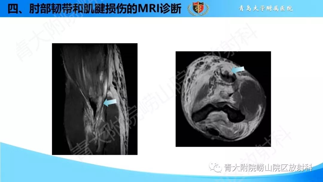 【PPT】肘部韧带和肌腱损伤的MRI诊断-43