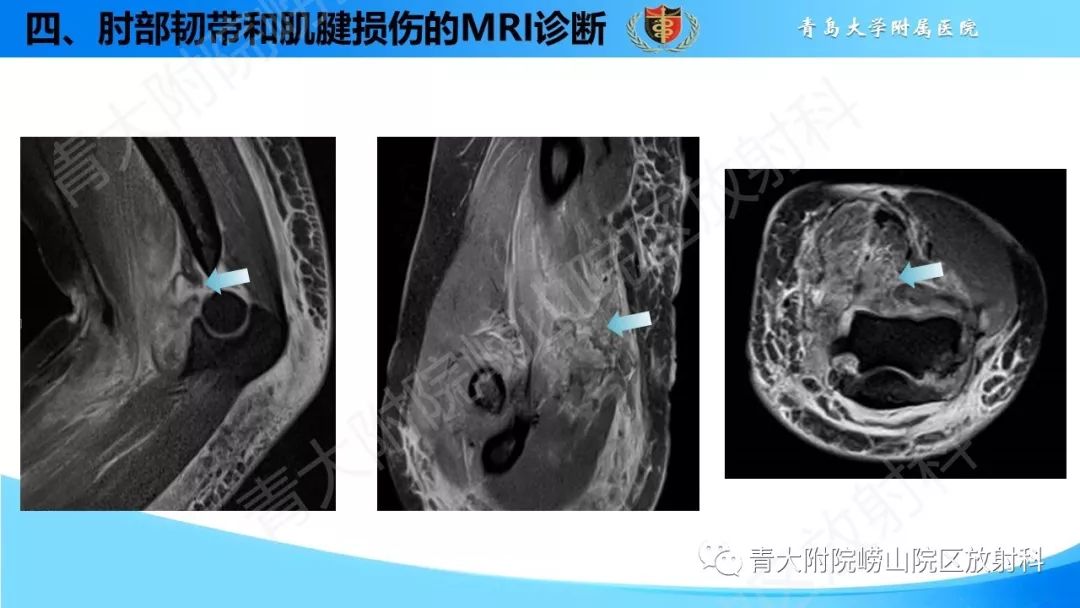 【PPT】肘部韧带和肌腱损伤的MRI诊断-46
