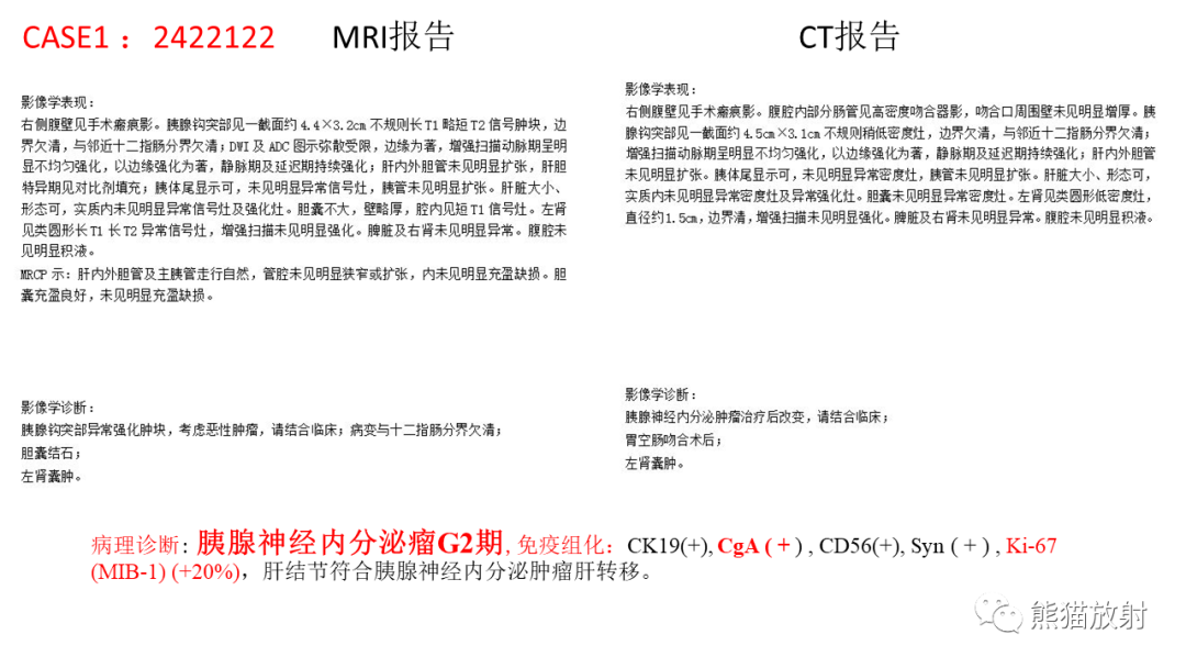 【病例】胰腺神经内分泌肿瘤2例CT及MR影像-16