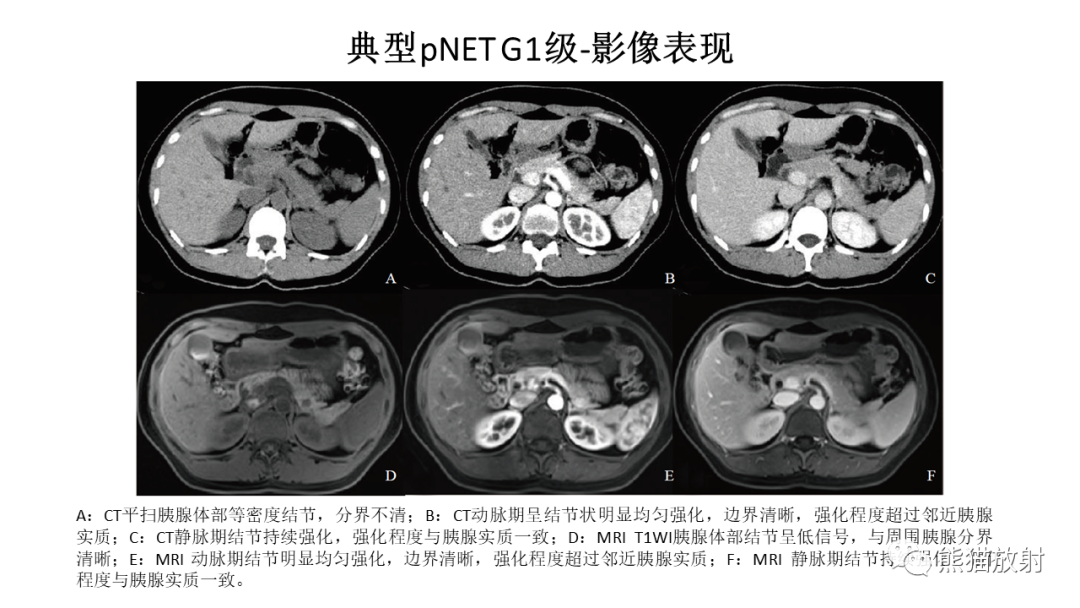 【病例】胰腺神经内分泌肿瘤2例CT及MR影像-24